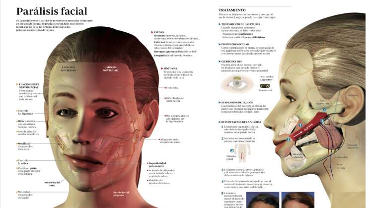 En temporada invernal aumentan casos de parálisis facial