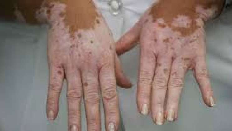 Científicos cubanos hallan cura contra el vitiligo