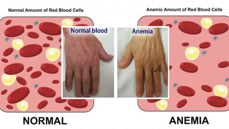 La anemia afecta al 25% de la población mundial