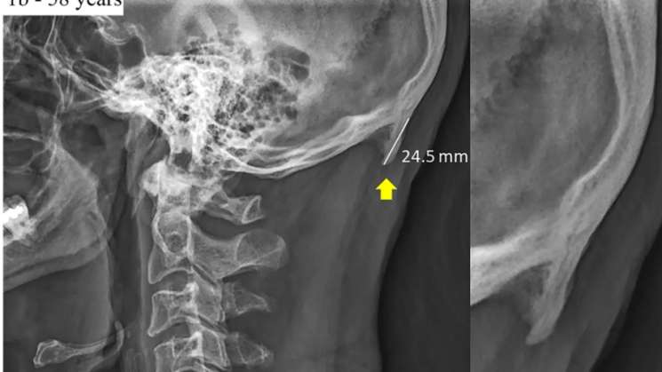 Uso exsesivo de celular crea cuerno en cráneo de usuarios