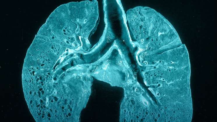 Fibrosis pulmonar, secuela en pacientes recuperados de COVID-19