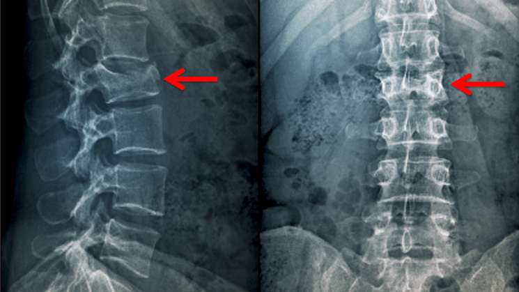 Produce Covid-19 fracturas vertebrales: Científicos italianos