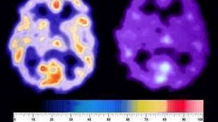 Bajo nivel de oxígeno daña el cerebro: Investigadores