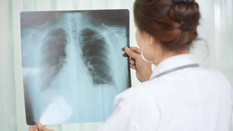 En México aumentan 45.3% casos de tuberculosis 