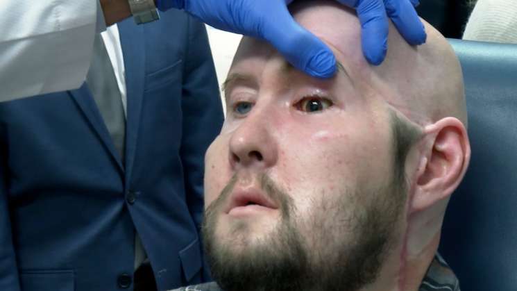 En EU realizan primer trasplante de ojos del mundo